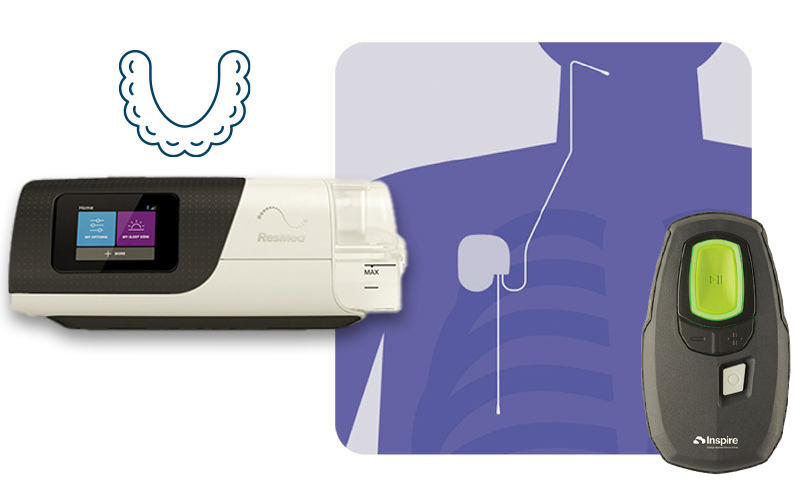 Mandibular advancement device (MAD)